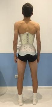 Corsetto Scoliosi